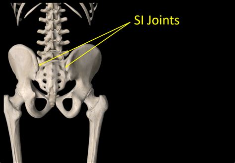 SI Joint Fusion Complications? Why Are We Doing this to Patients ...