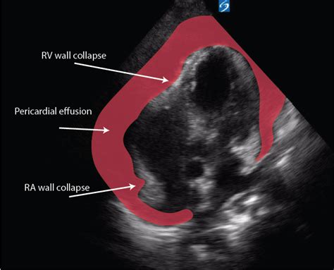 Pericardial Effusion Critical Care Sonography