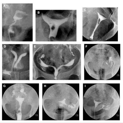 Materials Used During Hysterosalpingography Hsg Download