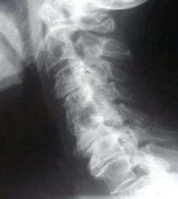 Explaining Spinal Disorders: Cervical Degenerative Disc Disease