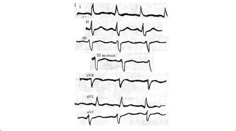 Sinus Tachycardia Digital Hybrid Education