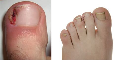 Ingrown Toenail Treatment Cure Or Surgery Phx Preferred Foot And Ankle