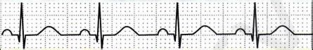 ecg rhythm flashcards quizlet