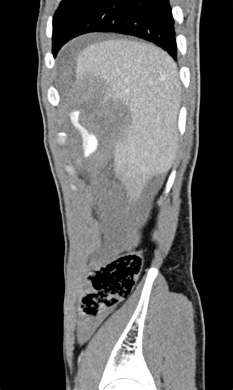 Liver Laceration Aast Grade Iv Image