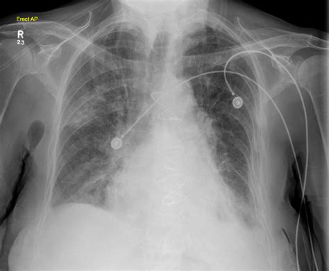 Bilateral Pneumonia Chest X Ray