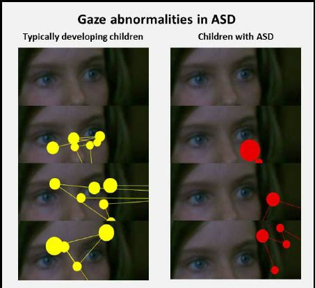 Example Of Characteristic Gaze Pattern To The Eyes In Three Typically