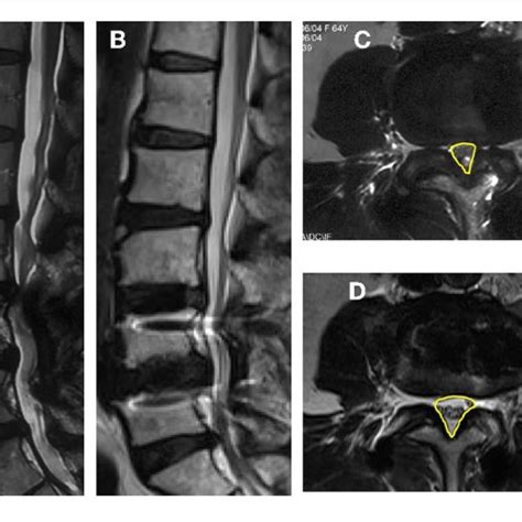 Images Obtained In A 62 Year Old Woman Who Had An L4 L5 Posterior Download Scientific Diagram