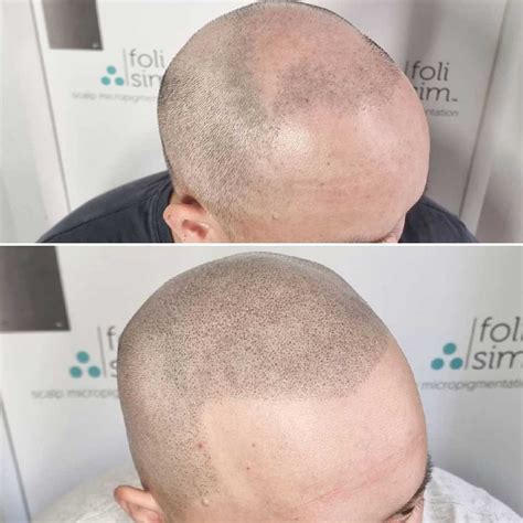 Scalp Micropigmentation Before and After Gallery - Best SMP Examples