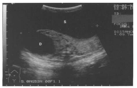 Axial ultrasound scan of the lower abdomen showing the dilated, fluid ...