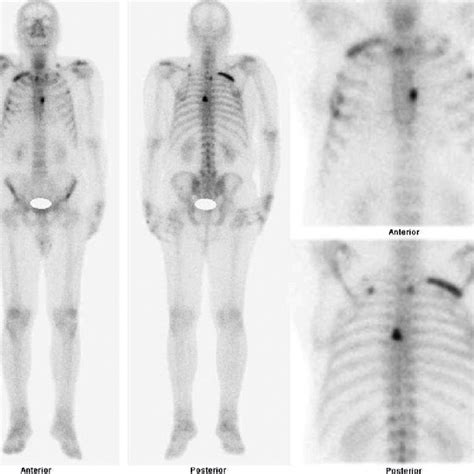 Whole Body Bone Scan With M Tc Methylene Diphosphonate Showing