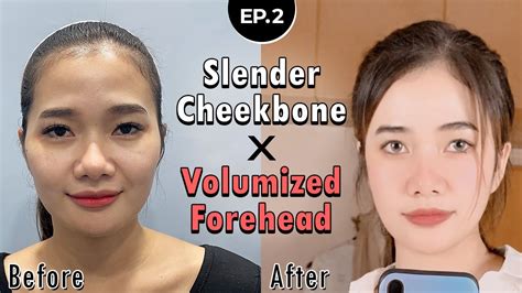 SUB Quick Cheekbone Reduction Full Face Fat Grafting Surgery In