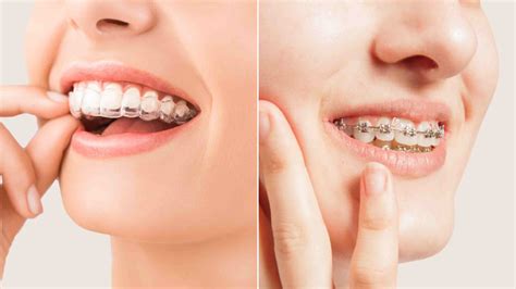 Braces Vs Aligners Which One To Choose