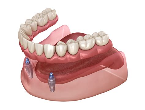 Implant Supported Dentures