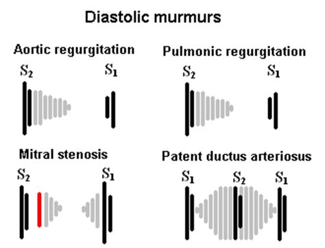 Aortic Regurgitation Murmur