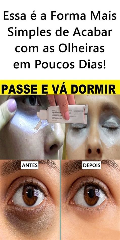 Essa é a Forma Mais Simples de Acabar as Olheiras em Poucos Dias