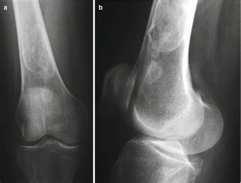 Bone Infarct Springerlink