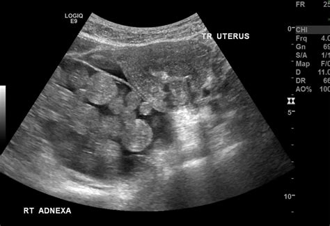 Cystic Ovarian Teratoma Intracystic Fat Globules Image