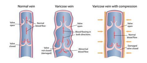 Varicose Veins — Vascular Cures