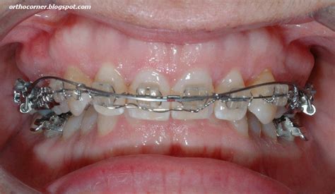 Orthodontic Corner Class Ii Div 2 Deep Bite Where Is The Limit