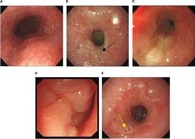 Frontiers Case Report A Rare Case Of Sintilimab Induced Gastric