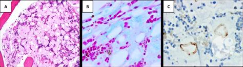 Severe Serous Fat Atrophy Of Bone Marrow