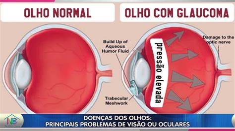 Doenças dos Olhos Principais Problemas de visão ou oculares YouTube