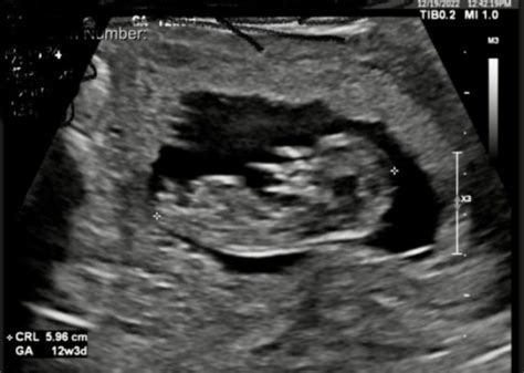 12 week ultrasound | BabyCenter