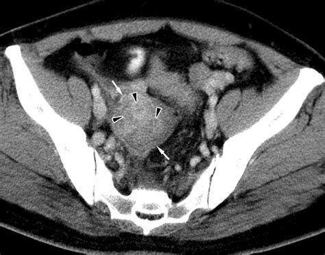 Unusual Causes Of Tubo Ovarian Abscess Ct And Mr Imaging Findings Radiographics