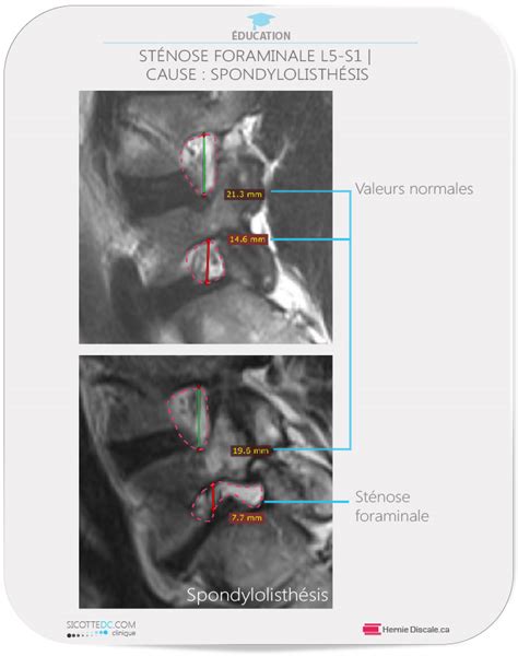 St Nose Foraminale Lombaire Spondylolisth Sis Ou Ant Rolisth Sis