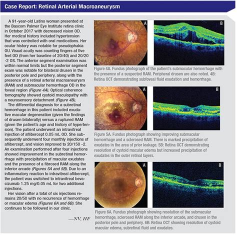 Managing Retinal Macroaneurysms