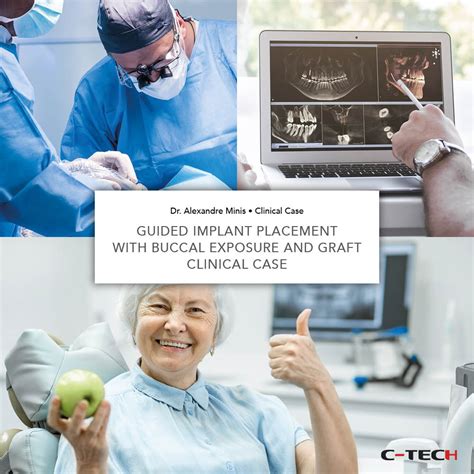 Guided Implant Placement With Buccal Exposure And Graft Clinical Case