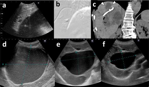 Case 3 69 Year Old Woman With Symptomatic Giant Hepatic Cyst Treated