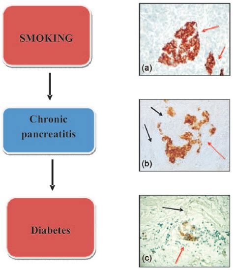 The Impact Of Smoking On The Development Of Diabetes And Its