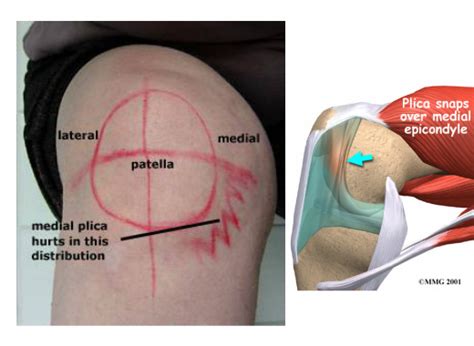 Knee Anatomy Plica