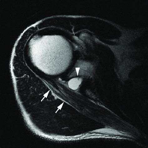 Spinoglenoid Notch Ganglion Axial T2 Weighted Image Demonstrating A