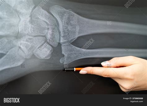 X-rays Fractured Image & Photo (Free Trial) | Bigstock