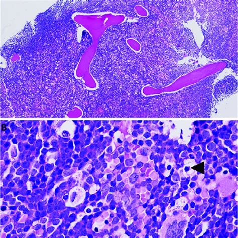 Bone Marrow Core Biopsy A Bone Marrow Core Biopsy 40x Trabecular