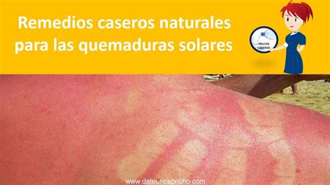 Remedios Caseros Naturales Para Las Quemaduras Solares Como Aliviar