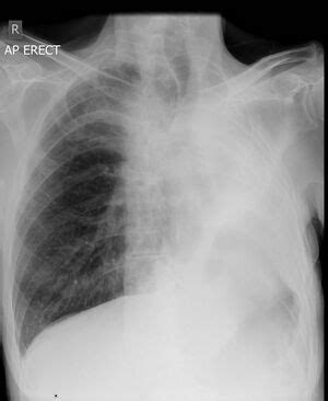 Pneumonectomy - Physiopedia