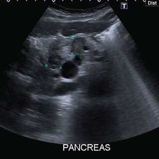 Ultrasound showing hypoechoic masses within the pancreas. | Download Scientific Diagram