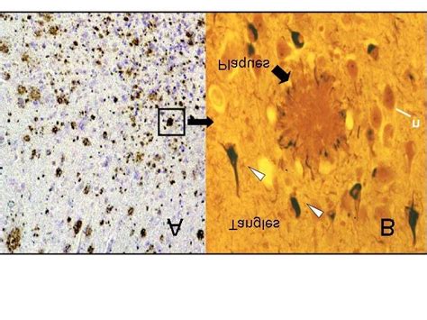 (A) Alzheimer's disease brain showing the typical amyloid plaques. (B ...