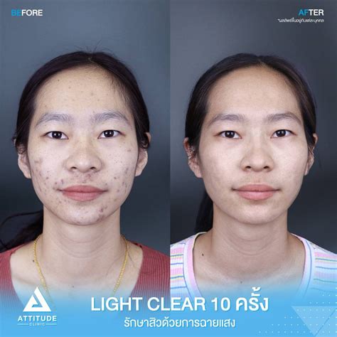 รีวิว Attitude Clinic ห้วยขวาง รีวิวรักษาสิวครบวงจร โปรแกรม Light