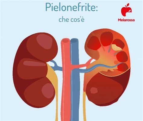 Pielonefrite Mata Em Quanto Tempo - Pielonefrite: cos’è, sintomi, cause, diagnosi e cura - Melarossa