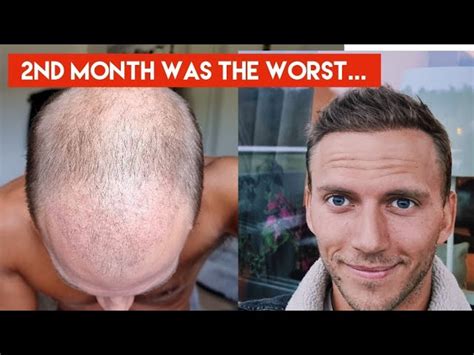 Top 132 First 10 Days After Hair Transplant Polarrunningexpeditions