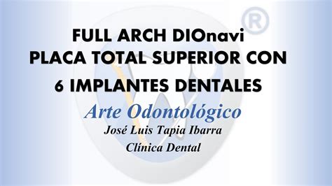 FULL ARCH DIOnavi Placa Total Superior O Con Implantes Dentales