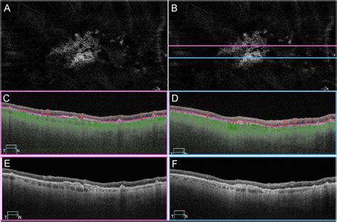 Octa Imaging Of Cnv In Patient Ga Ss Octa En Face And B Scan Imaging