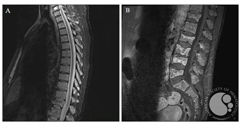 Multiple myeloma - MRI