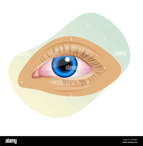 Fungal Infection in Eye Irritant - Pink Eye - Icon as EPS 10 File Stock ...