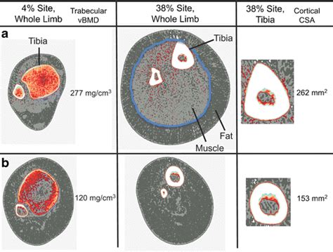 Peripheral Quantitative Computed Tomography Images At The Distal Tibia