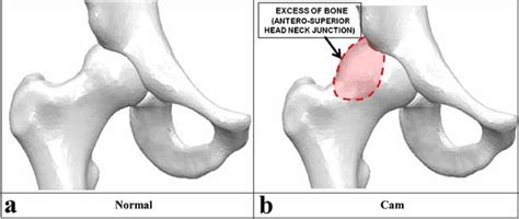 Changes In The Stress In The Femoral Head Neck Junction After